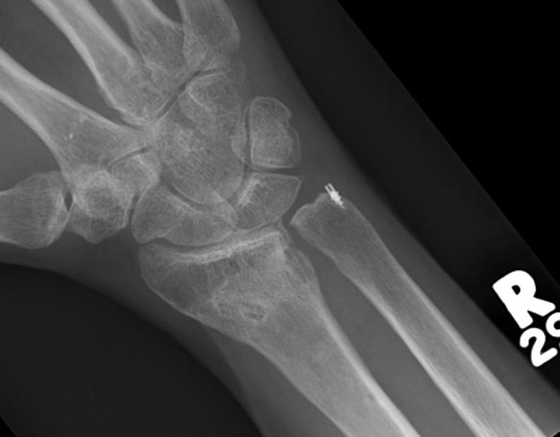 DRUJ Arthritis The Bone School